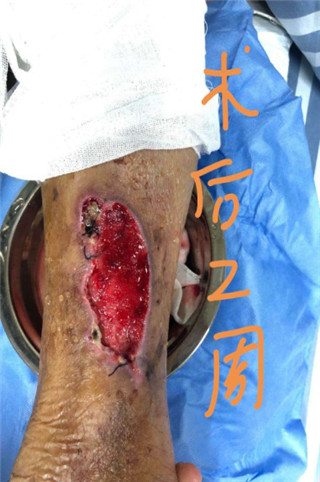 手术 -成功治疗下肢溃疡伴皮肤坏死一例