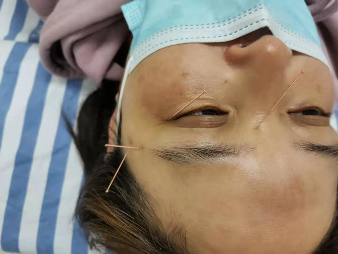 中医特色显身手江宁中医院采用针灸技术治疗眼肌麻痹
